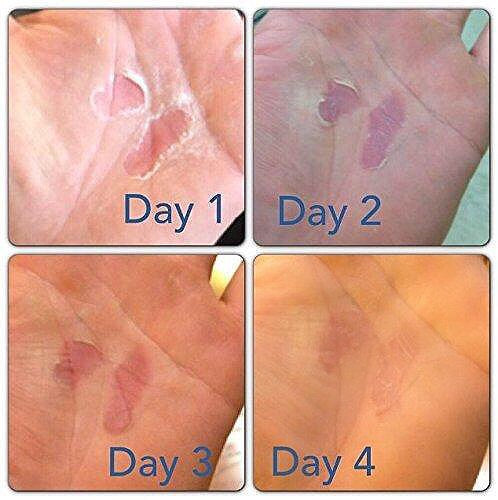 How To Heal Calluses, Blisters, and Skin Rips - RipFix - 3-Pack Travel Size Tins (0.3oz)